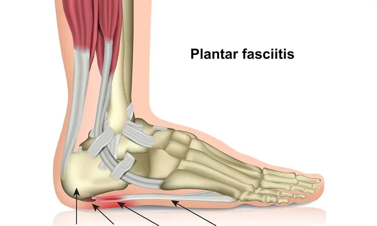 Anatomische Darstellung des Fußes, die zeigt, wie die Plantarfasziitis immer schlimmer wird, mit Entzündung an der Ferse.