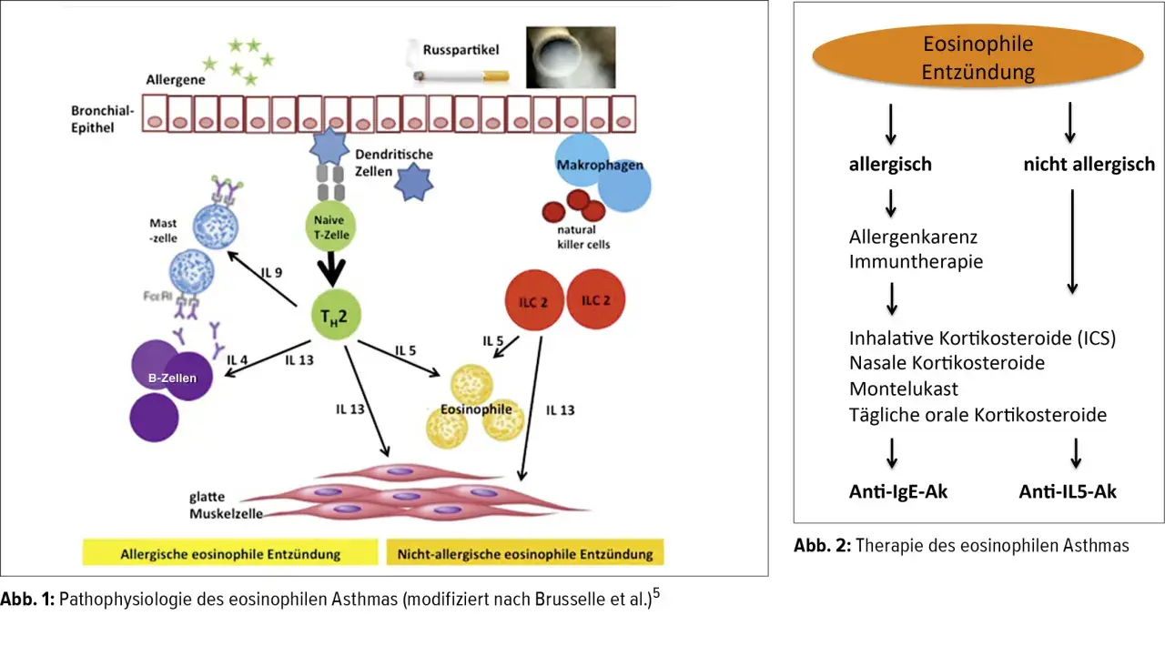 Schema zeigt eosinophile Entzündung bei Asthma: Allergene aktivieren Zellen, die zu TH2-Zellen und Eosinophilen führen. Abb. 2 zeigt Therapieansätze.