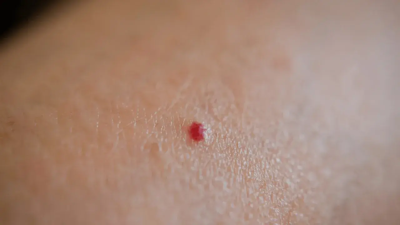 Piccola macchia rossa sulla pelle, un neo rubino che non prude.