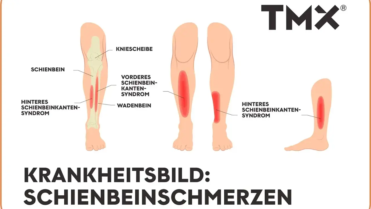 Illustrationen zeigen verschiedene Ursachen für starke Schmerzen im Schienbein im Ruhezustand, wie das vordere und hintere Schienbeinkantensyndrom.