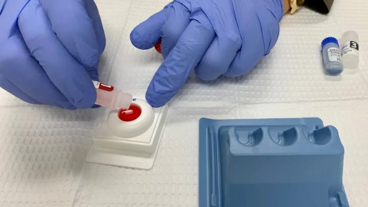 Manos enguantadas realizan prueba rápida para diagnóstico y tratamiento de gonorrea.