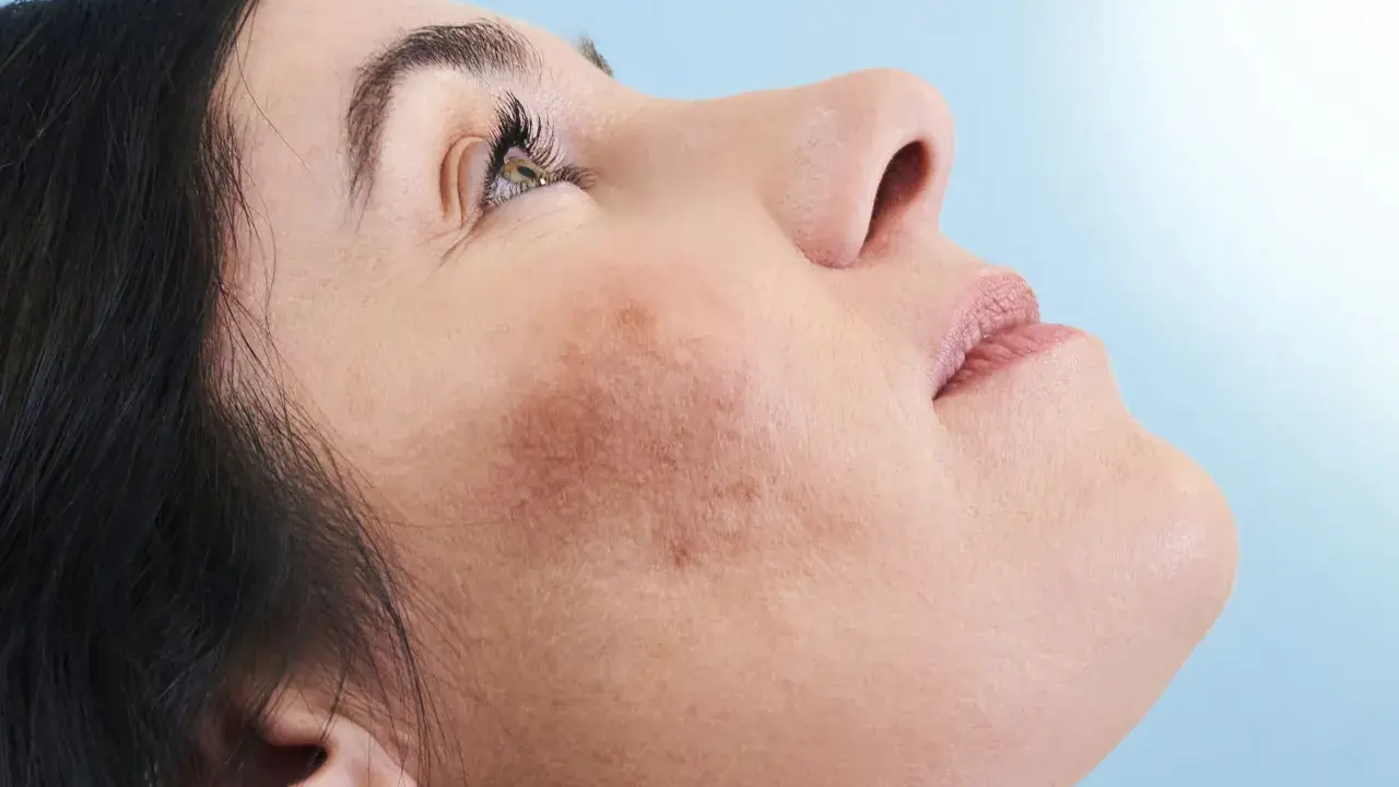 Primo piano del viso di una donna con macchie cutanee visibili, che mostra come coprire le macchie sul viso per un incarnato uniforme.