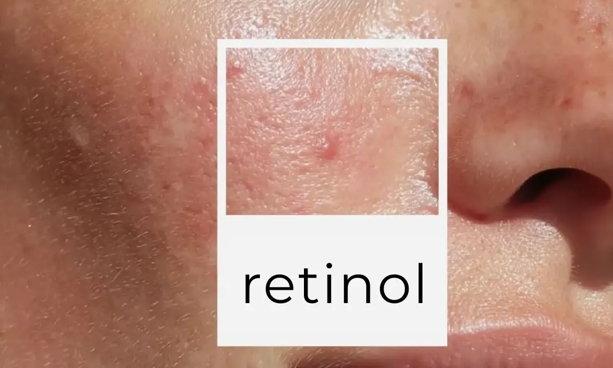 Zbliżenie na skórę z widocznymi niedoskonałościami, zaczerwienieniami i wypryskami. W ramce tekst "retinol", sugerujący wysyp po retinolu.