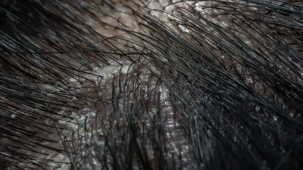 Gros plan sur un cuir chevelu présentant des pellicules grasses, avec des cheveux noirs fins qui poussent à travers.