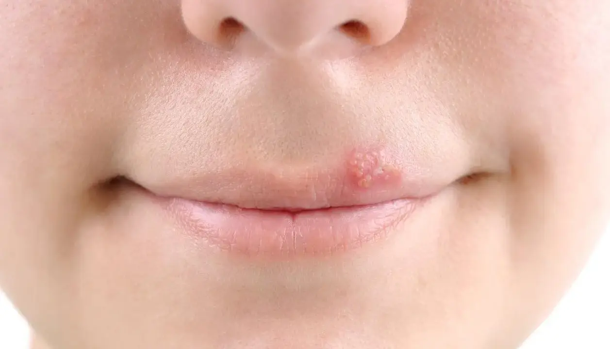 Bouton de fièvre sur la lèvre, un signe qu'il faut trouver un remède rapidement.