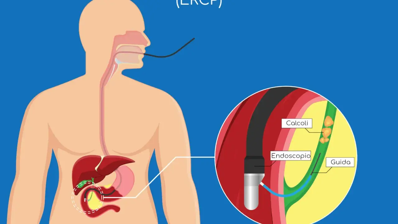 ERCP: endoscopio inserito per rimuovere calcoli che causano ostruzione coledoco.