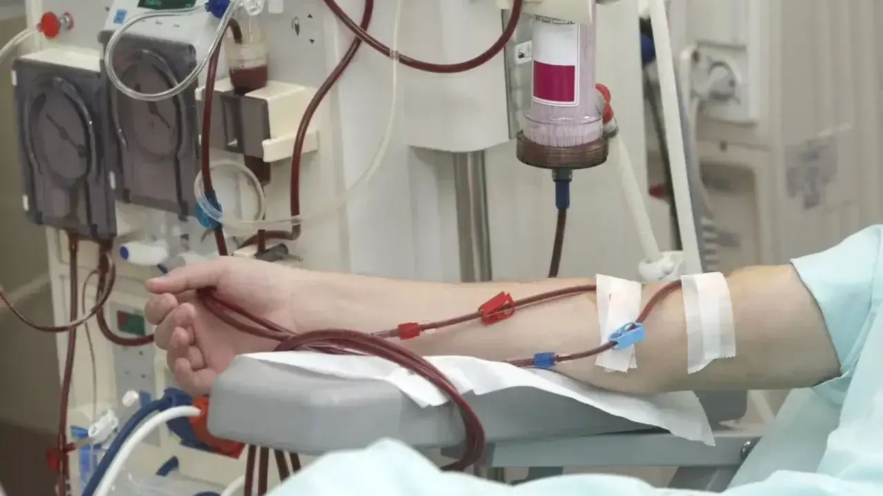 Ramię pacjenta podłączone do aparatury do dializy. Rozważamy dializa otrzewnowa wady i zalety.