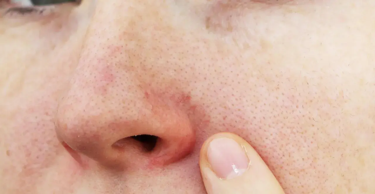 Gros plan sur un nez avec une légère rougeur autour des narines et des pores visibles. Un doigt effleure la peau.