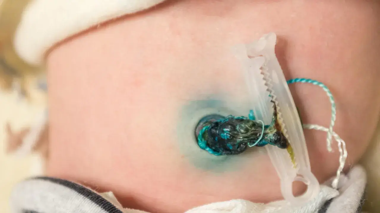 Piccolo granuloma ombelicale con clip e cordone residuo su pelle neonatale.