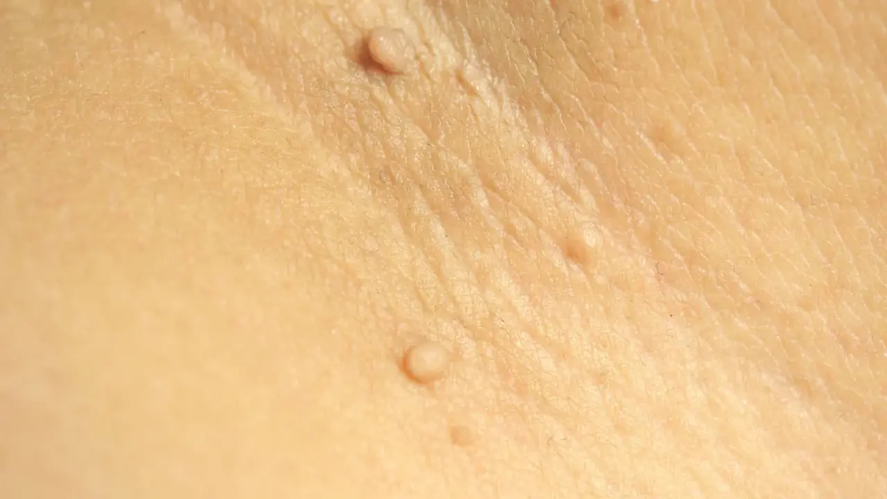 Gros plan sur une peau claire montrant plusieurs petites excroissances cutanées, certaines ressemblant à des grains de beauté ou des verrues.
