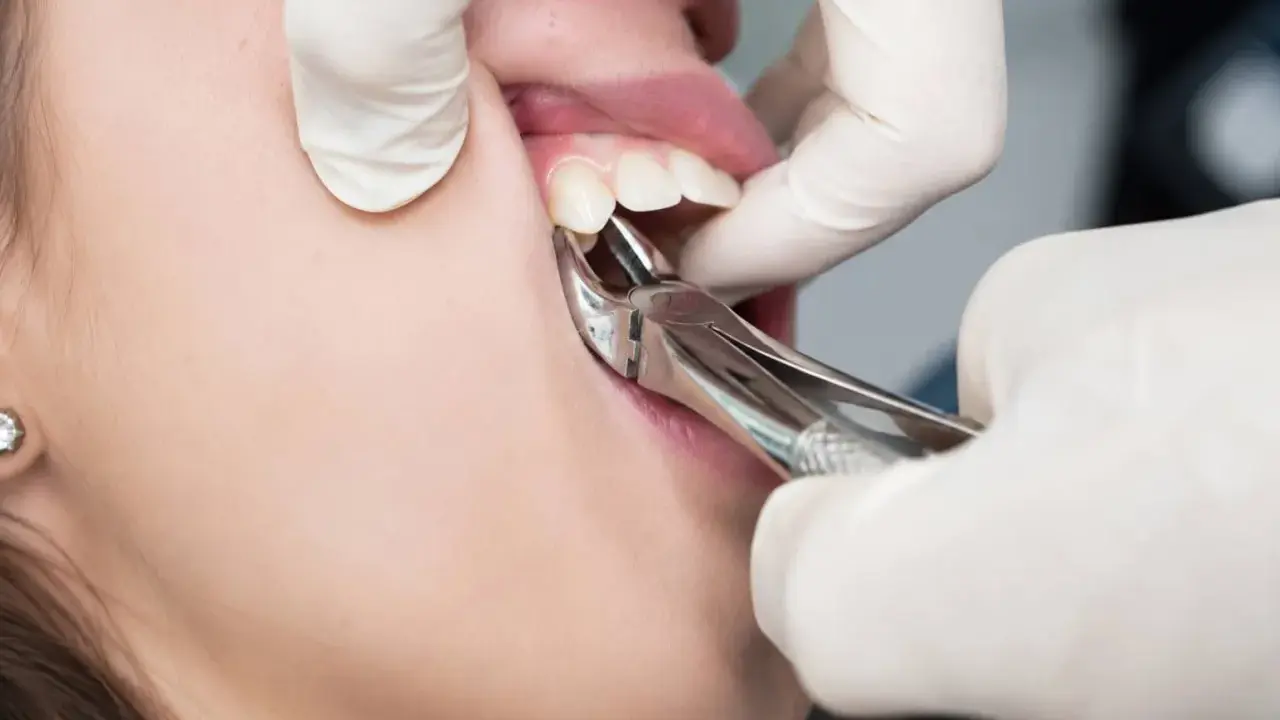 Chirurgiczne usuwanie zęba w trakcie zabiegu. Dentysta w białej rękawiczce używa kleszczy stomatologicznych.