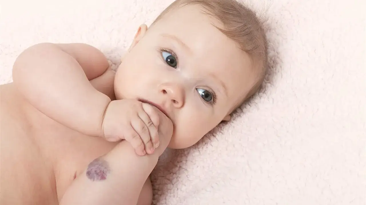 Bebé con un angioma en el brazo, mirando a la cámara con curiosidad.