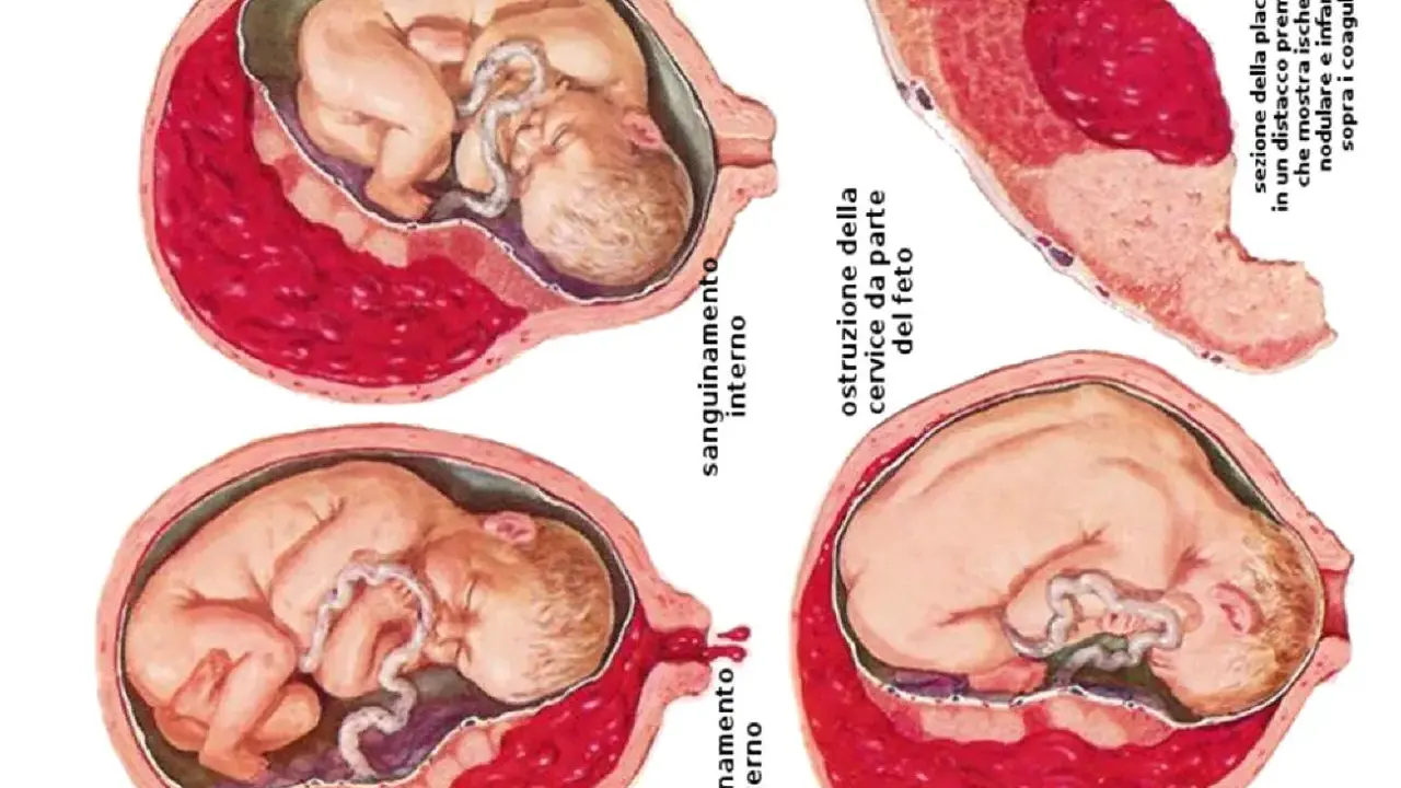 Illustrazioni mediche mostrano complicazioni della gravidanza: sanguinamento interno/esterno, ostruzione cervicale e distacco prematuro della placenta, evidenziando la placenta bassa.