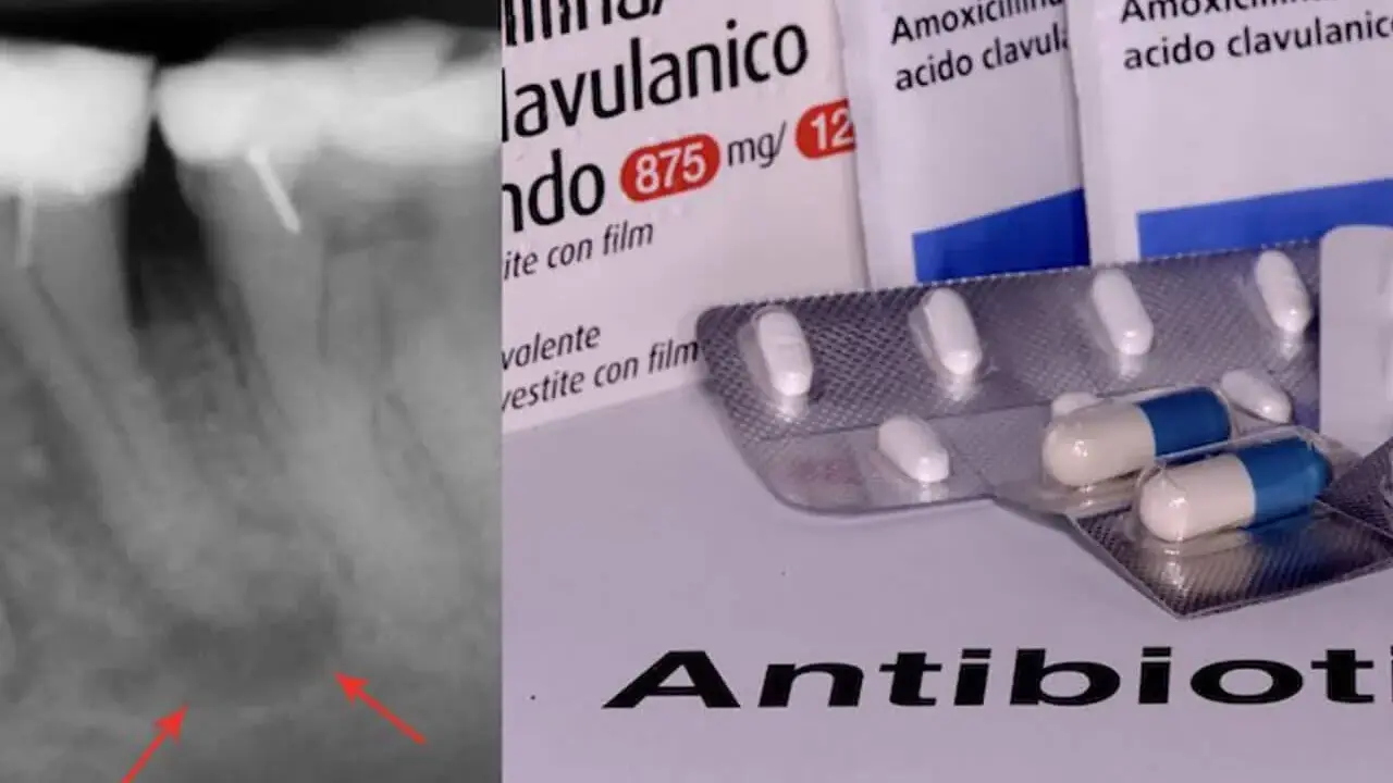 Radiografia dentale con segni di infezione e confezioni di amoxicillina/acido clavulanico, un antibiotico e antinfiammatorio.