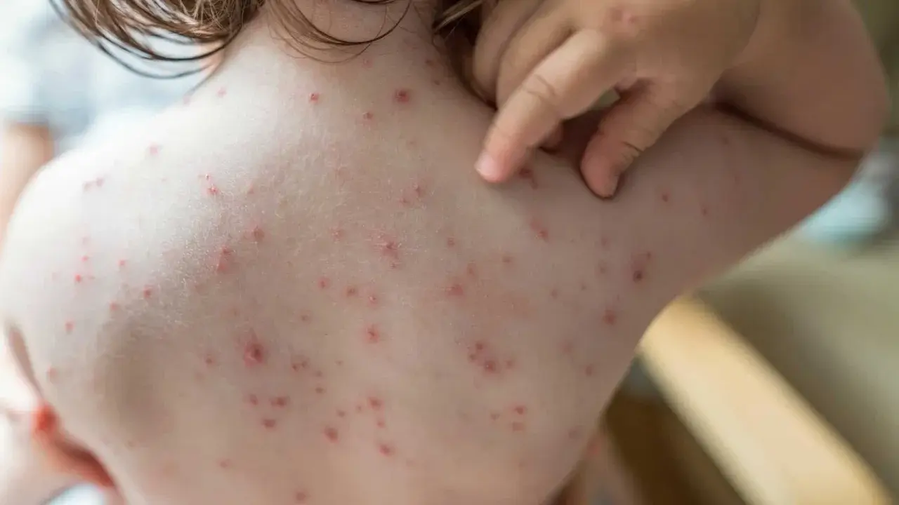 Un enfant se gratte le dos couvert de boutons de varicelle. Le traitement de la varicelle vise à soulager les démangeaisons.