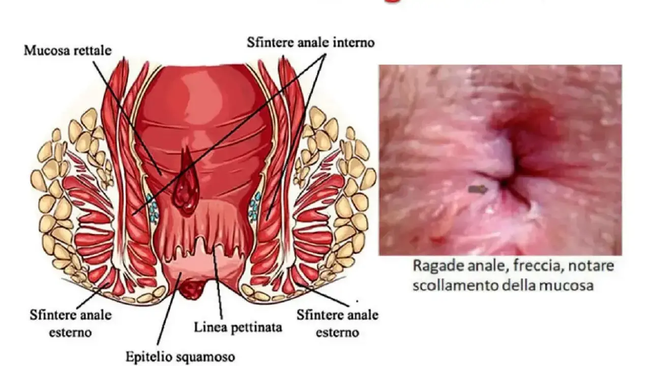Illustrazione anatomica dell'ano e immagine ravvicinata di una ragade anale con freccia che indica lo scollamento della mucosa. Si notano puntini bianchi nell'area anale.