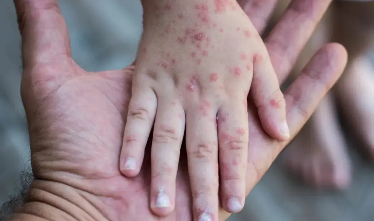 Mano de niño con erupciones rojas, síntoma de sarampión en niños, descansando sobre la mano de un adulto.