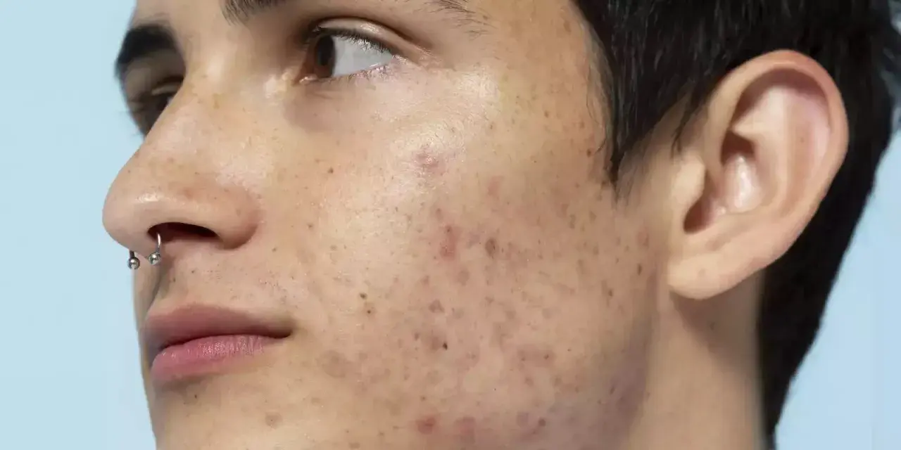 Primo piano del volto di un giovane con piercing al naso, che mostra le imperfezioni della pelle come brufoli e macchie.