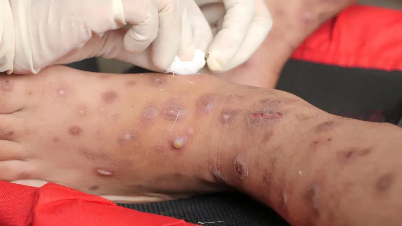 Mani guantate applicano un trattamento su una gamba affetta da scabbia. La temperatura ideale per uccidere la scabbia è di 50°C.
