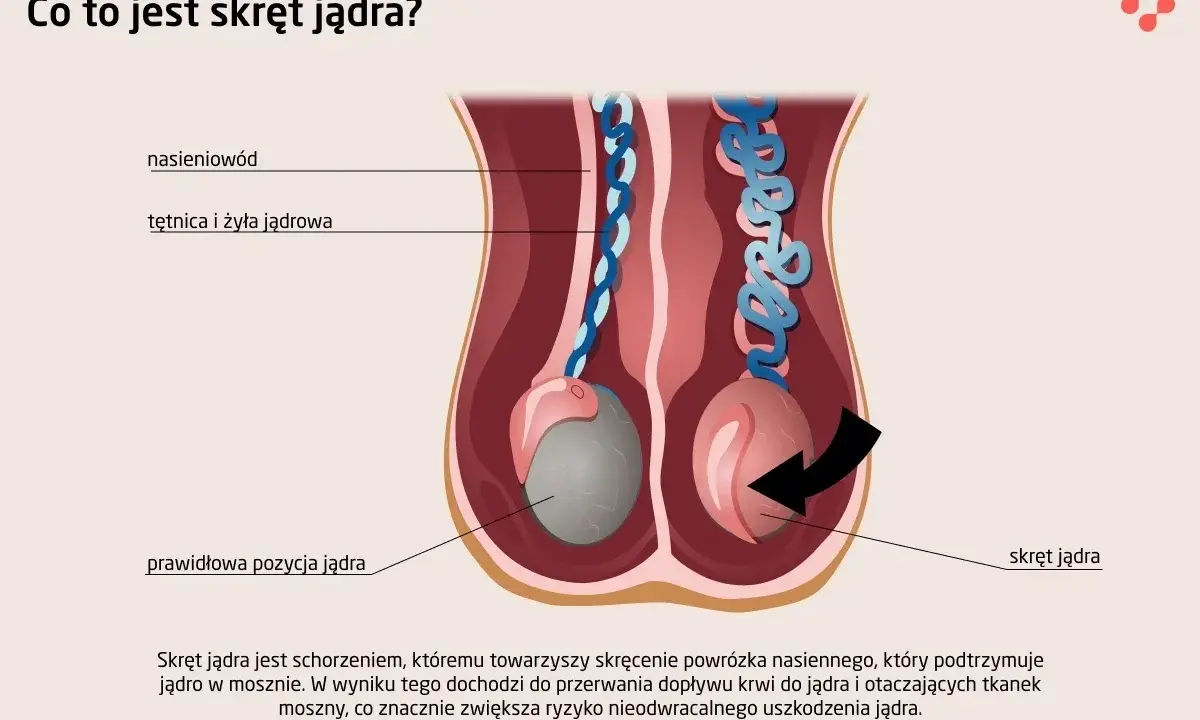 Ilustracja pokazuje skręt jądra, stanowiący przyczynę silnego bólu jądra, gdzie powrózek nasienny ulega skręceniu, blokując dopływ krwi.