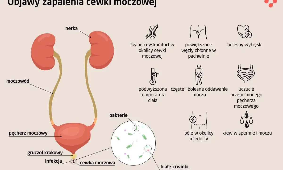 Objawy niebakteryjnego zapalenia cewki moczowej: świąd, ból, pieczenie, częste oddawanie moczu, gorączka, powiększone węzły chłonne.