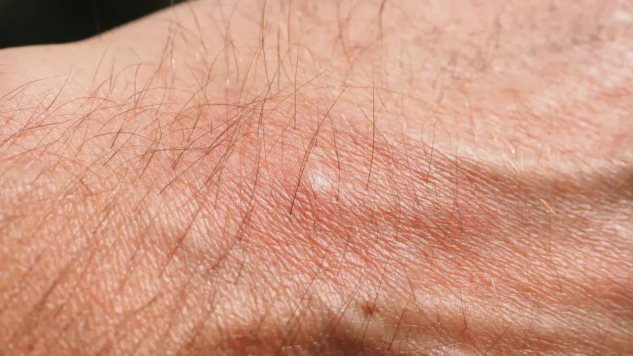 Pelle secca e arrossata con peli sottili, possibile prurito senile. Il trattamento per la xerosi cutanea è fondamentale.