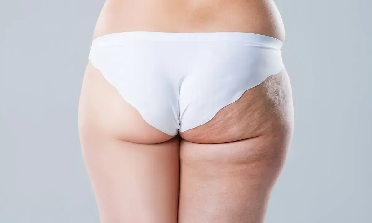 Vue arrière d'une femme en culotte blanche, montrant la cellulite sur sa cuisse.