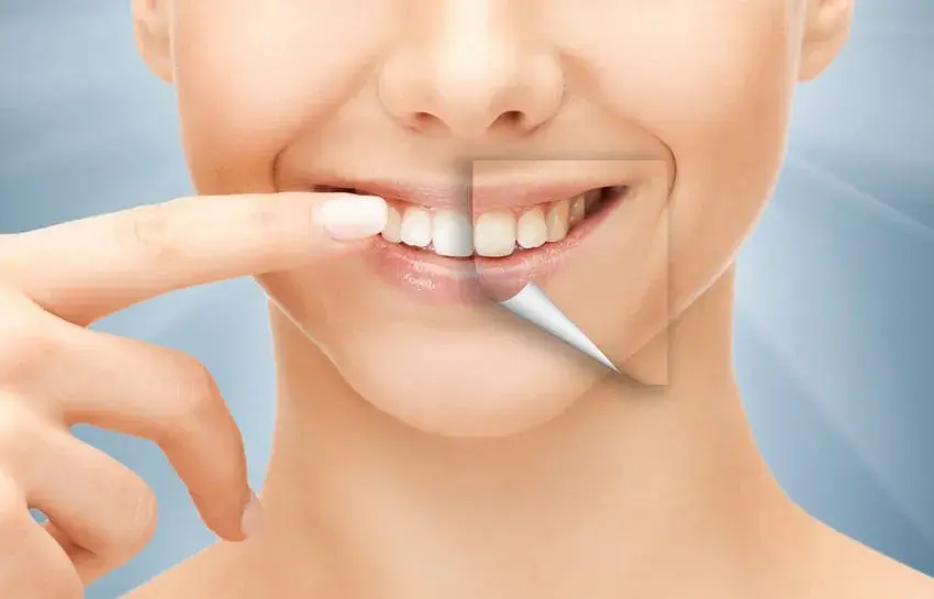 Ile kosztuje Hollywood Smile: kompletny cennik zabiegów w 2025 roku