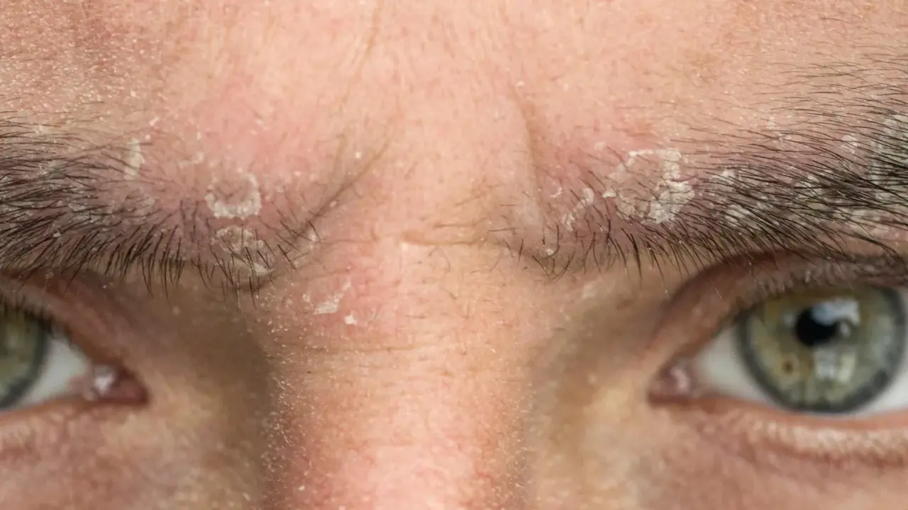 Gros plan sur un sourcil qui gratte et pèle, avec des squames blanches visibles sur la peau et entre les poils.