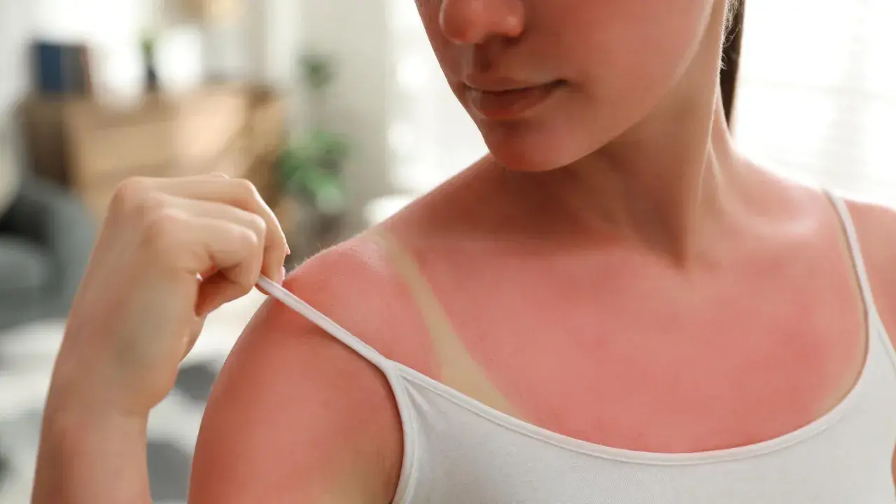 Épaule rouge vif, signe d'un coup de soleil. Une main tire la bretelle d'un débardeur blanc, révélant la peau brûlée par le soleil. Que mettre sur un coup de soleil ?