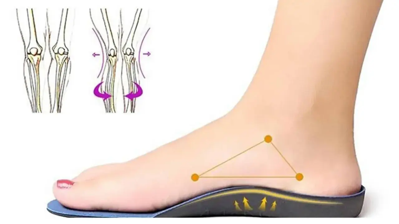 Un pied avec une semelle orthopédique, montrant le soutien. Le podologue utilise ces semelles pour corriger la posture.