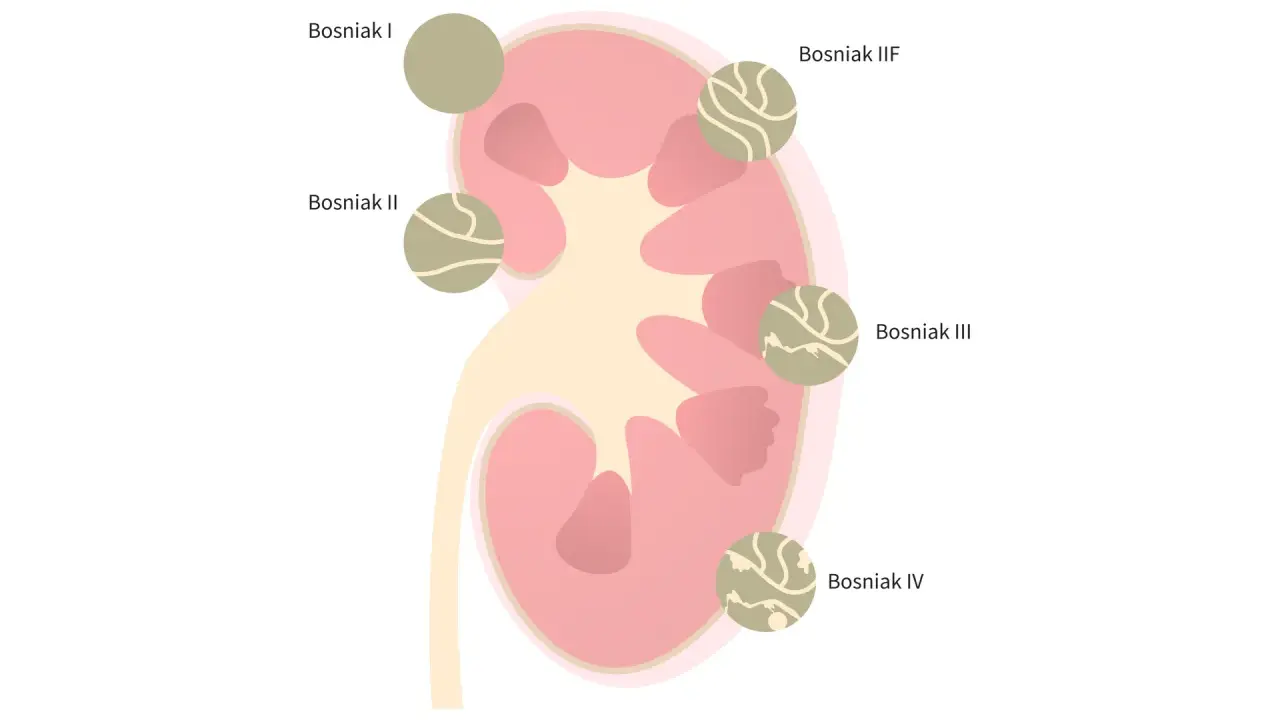 Schemat klasyfikacji torbieli na nerce w skali Bosniak. Różne stopnie torbieli: I, II, IIF, III, IV.