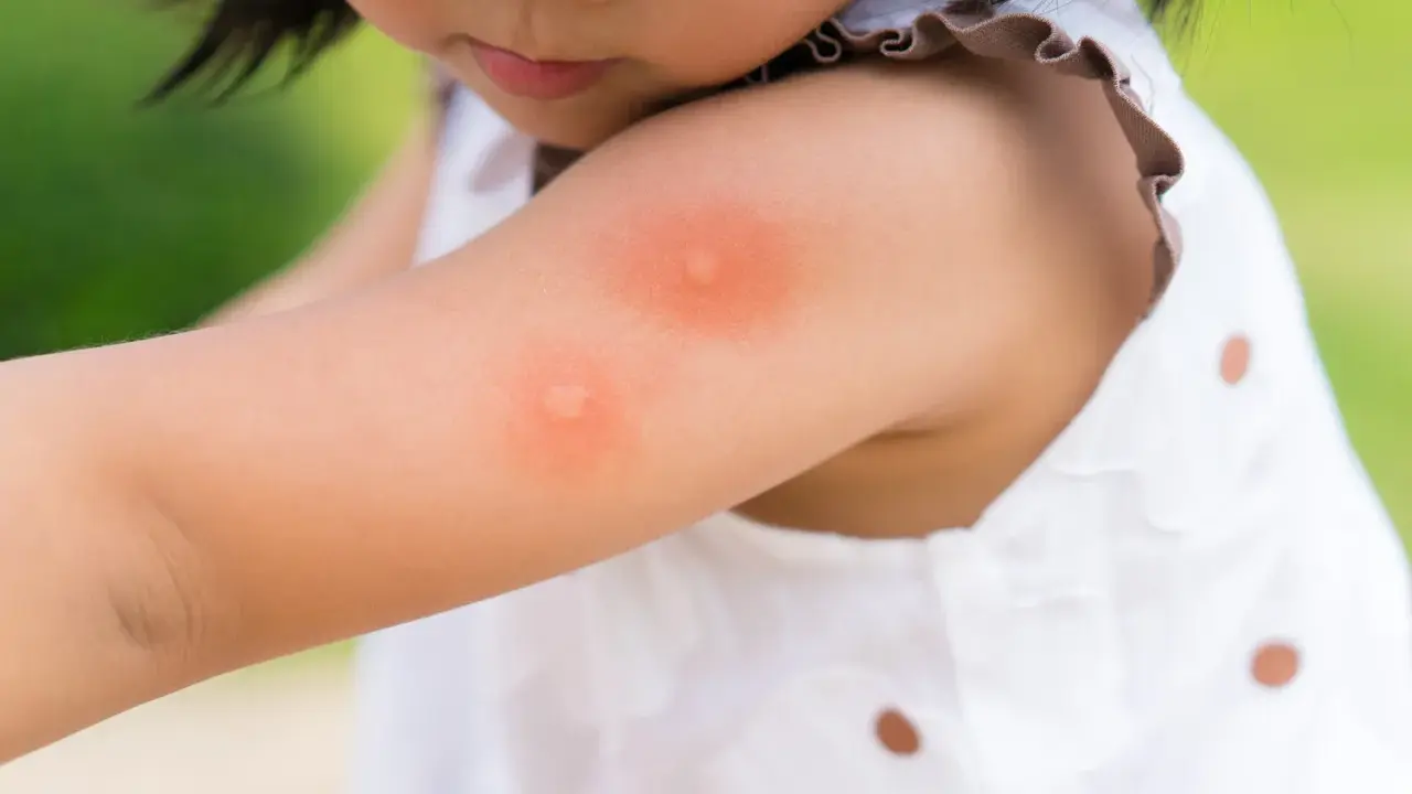 Enfant avec une piqûre d'insecte sur le bras. Une huile essentielle pourrait soulager la démangeaison.