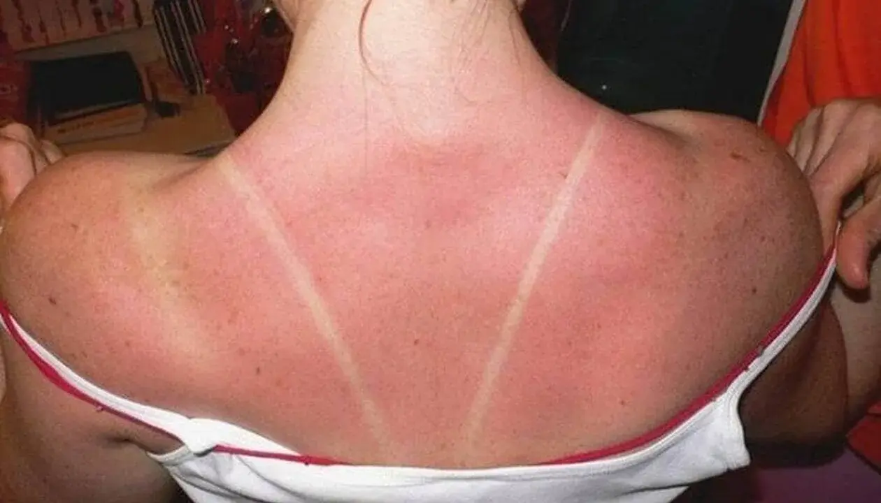 Dos lignes claires sur un dos rouge vif, témoignage d'un coup de soleil. Pour savoir comment faire dérougir un coup de soleil, il faut hydrater et apaiser la peau.