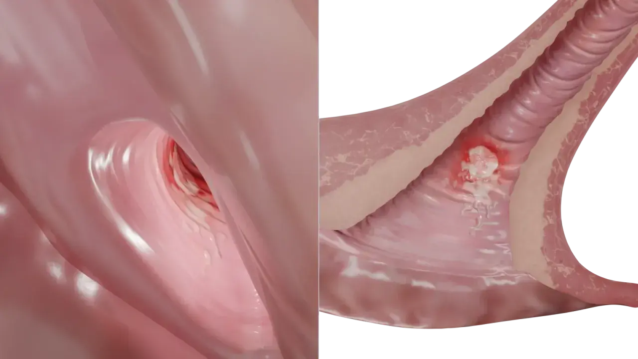Representación de una llaga o chancro, síntoma temprano de la sífilis en mujeres.