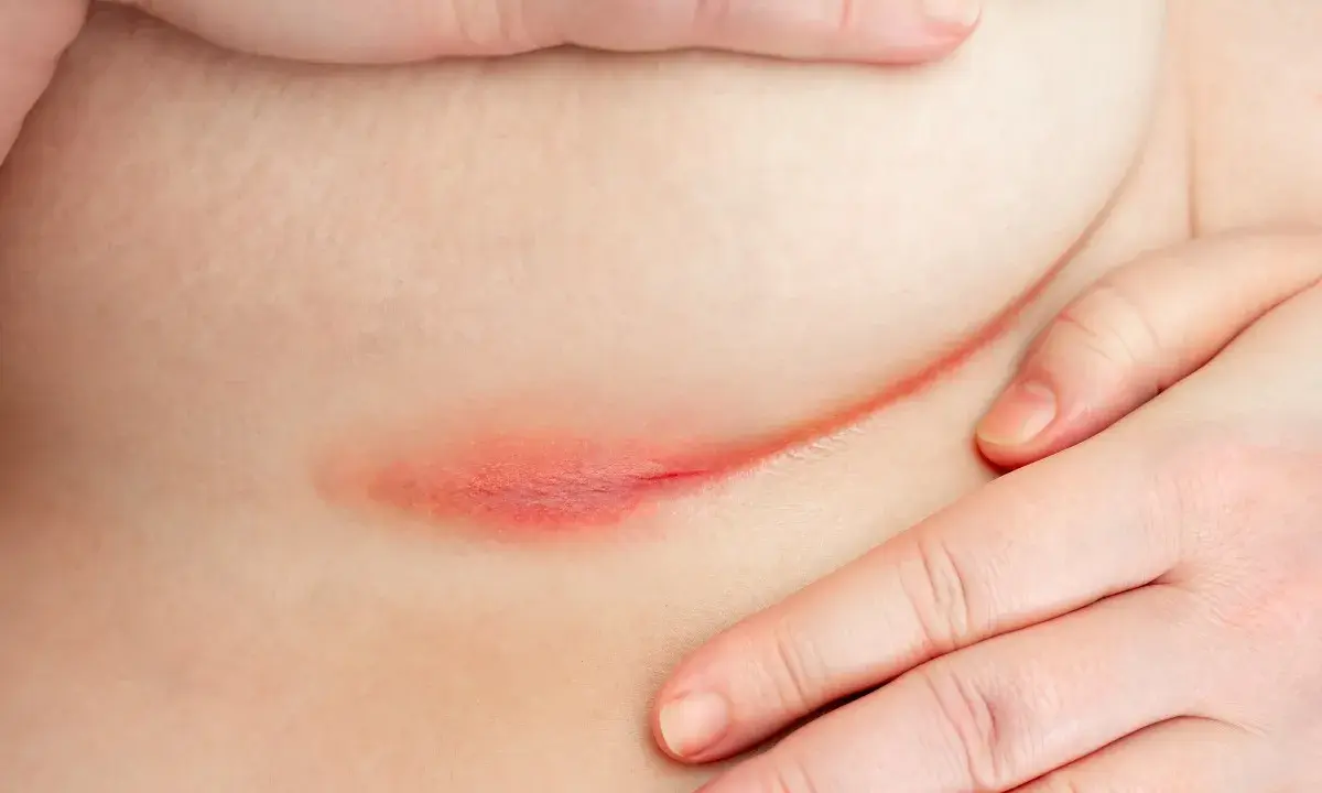 Irritazione cutanea sotto il seno, con rossore e possibile puzza dovuta all'umidità e al calore.