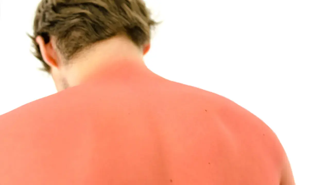 Schiena arrossata dal sole, un ricordo di una giornata intensa. Forse un po' di cefixoral per alleviare il bruciore.
