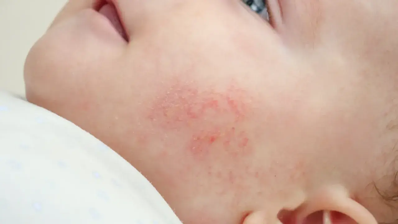 Un petit bouton rouge sur la joue d'un nourrisson, signe d'une peau sensible.