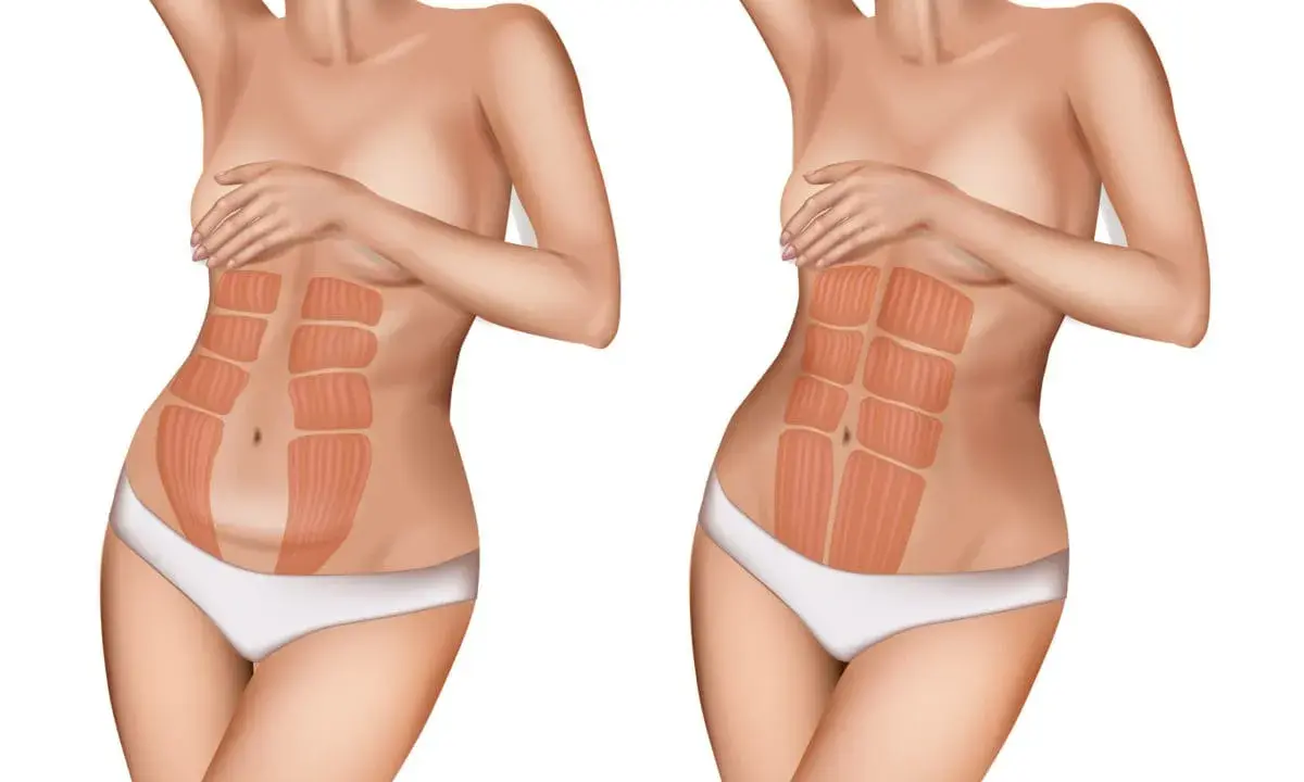 Vergleich zweier Bäuche: links ein Bauch nach Schwangerschaft mit deutlicher Trennung der Bauchmuskeln, rechts ein straffer Bauch mit sichtbaren Muskelpaketen.
