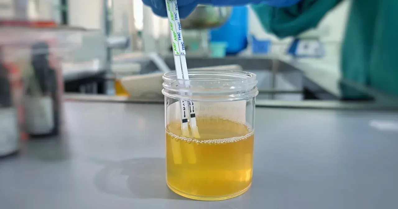 Testy paskowe zanurzone w próbce moczu, wskazujące na badanie pęcherza moczowego.