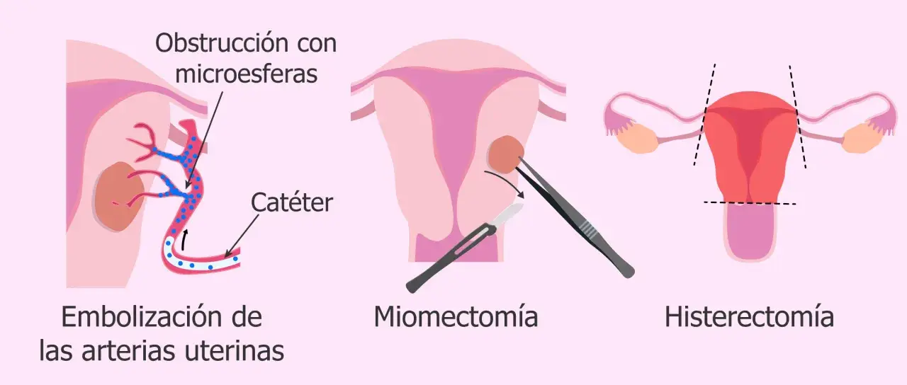 Ilustración de tratamientos para el mioma uterino: embolización, miomectomía y<bos> Histerectomía.