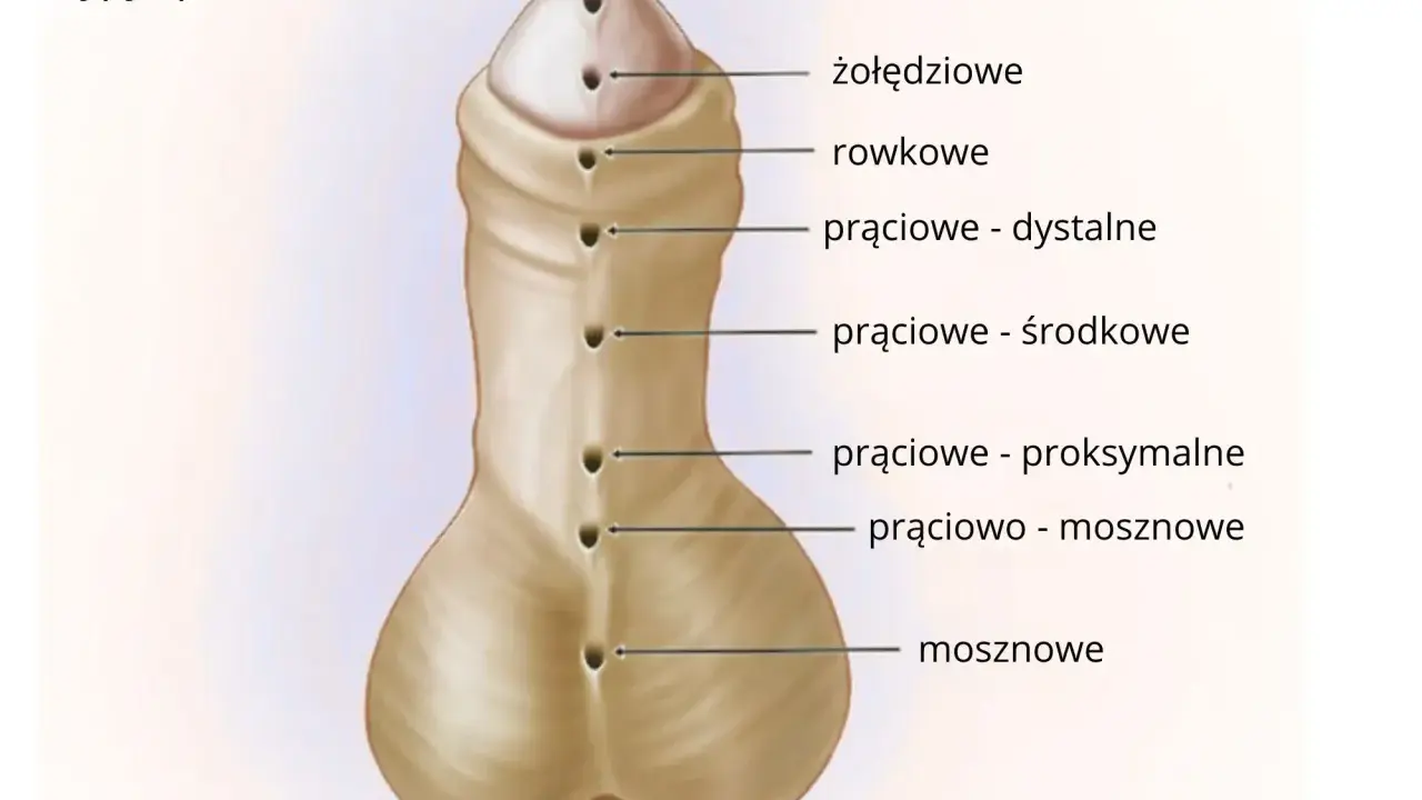 Ilustracja przedstawia typy spodziectwa, czyli wady rozwojowe cewki moczowej. Różne lokalizacje ujścia cewki mogą wpływać na obniżenie cewki moczowej objawy.