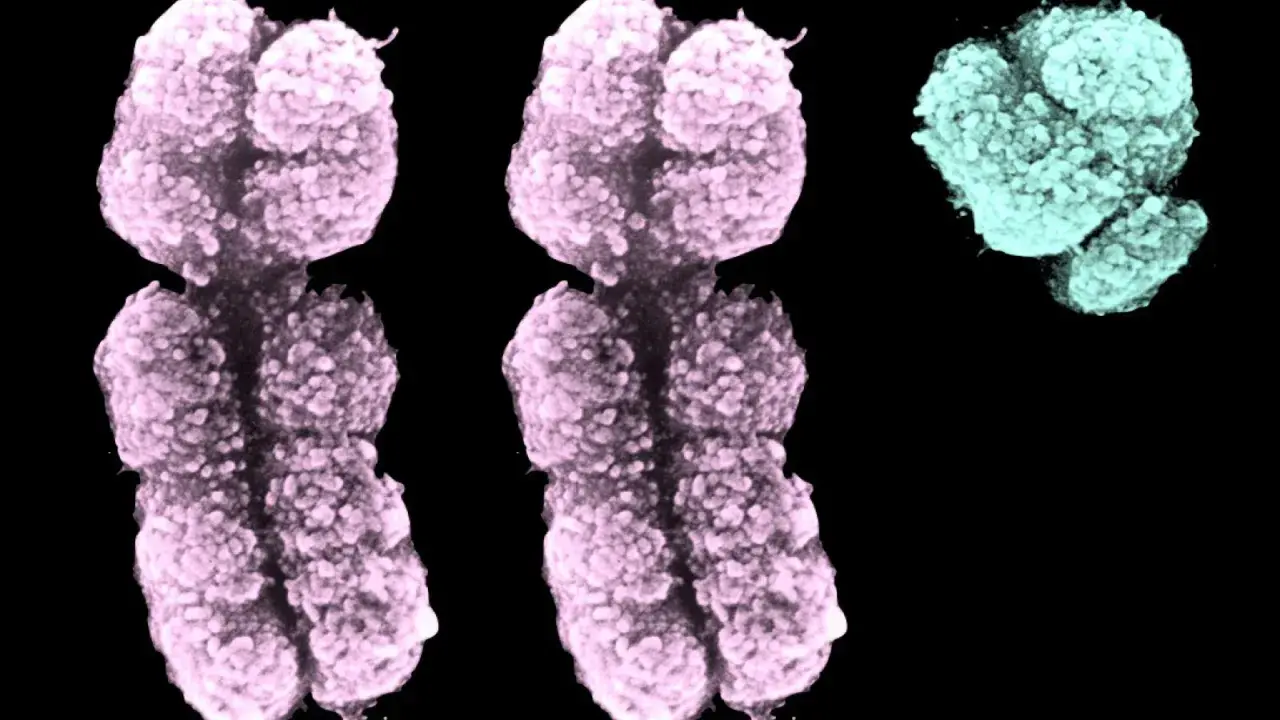 Cromosomi colorati, due rosa e uno turchese, che illustrano la sindrome XXY.