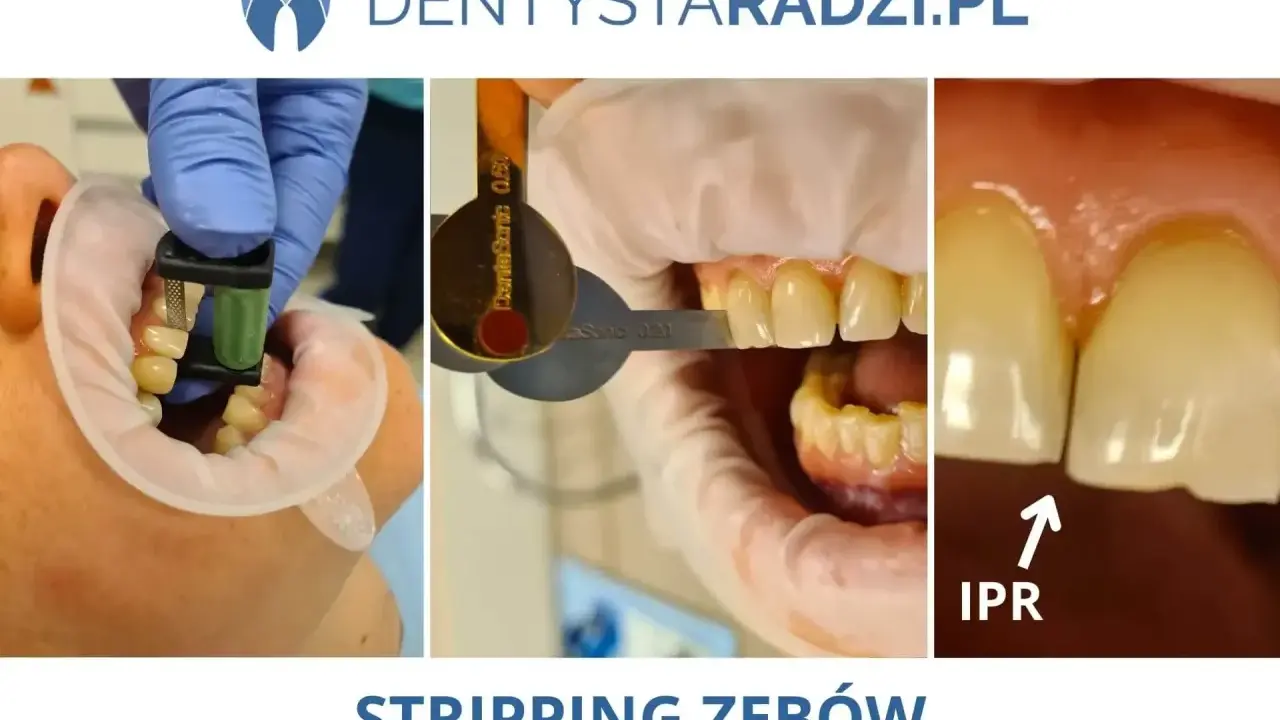 Stripping zębów: przed zabiegiem z użyciem narzędzi i po, widoczna poprawa przestrzeni międzyzębowych (IPR).