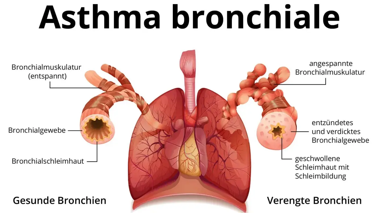 Vergleich gesunder und verengter Bronchien bei Asthma. Symptome wie angespannte Muskulatur und Schleimbildung führen zu Atemnot.