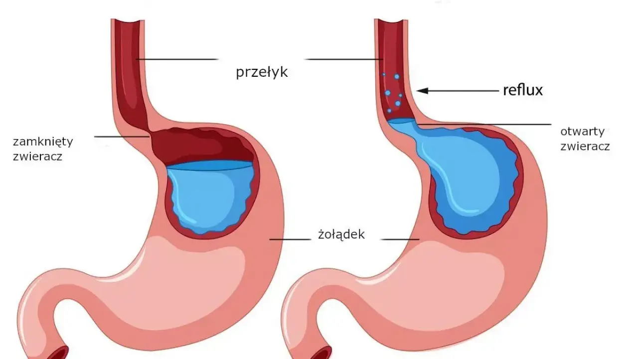 Schemat żołądka z otwartym zwieraczem, pokazujący refluks i powodujący pieczenie w żołądku.