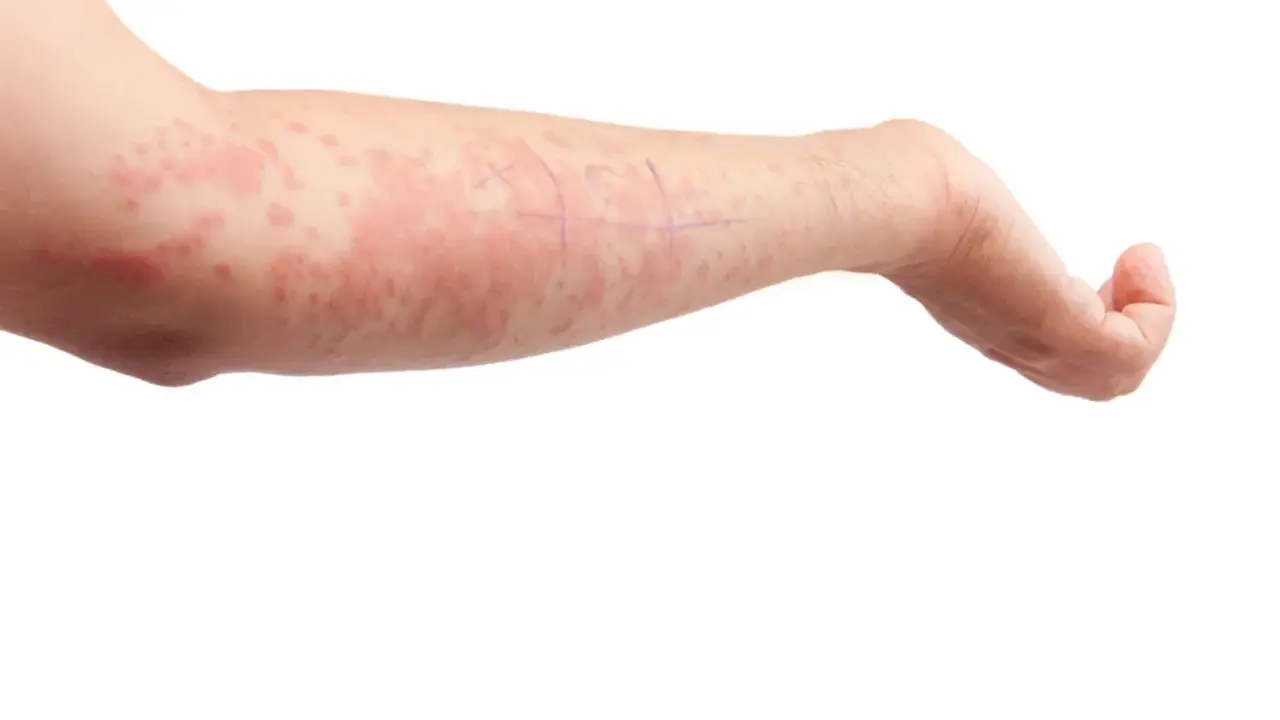 Braccio con eruzione cutanea rossa e pruriginosa, indicativa di orticaria papulosa. Segni a matita sulla pelle.