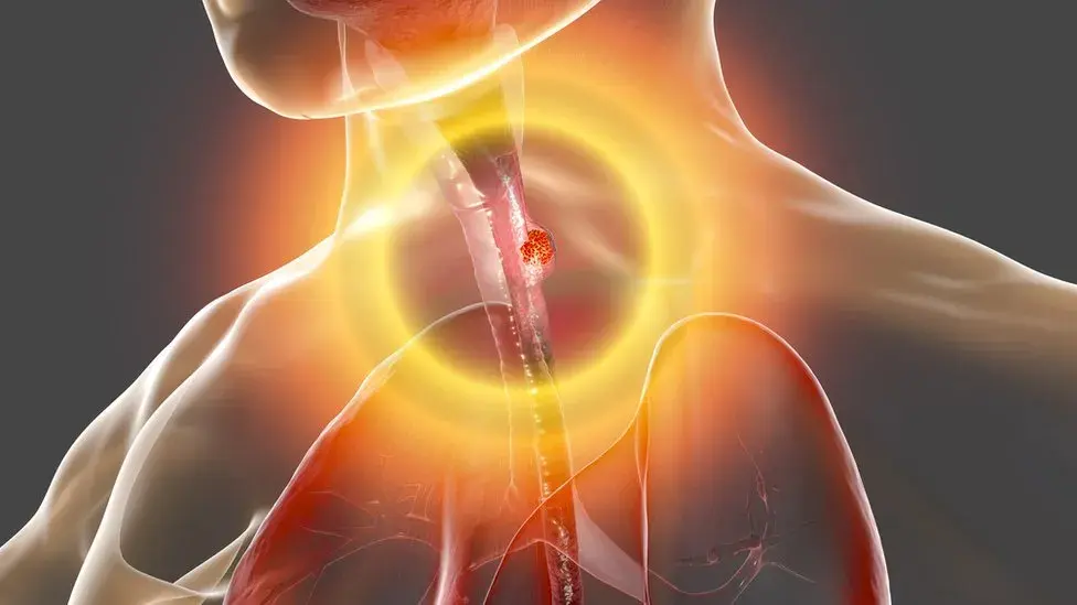 Cáncer de esófago: síntomas clave que no debes ignorar. ¿Los conoces?