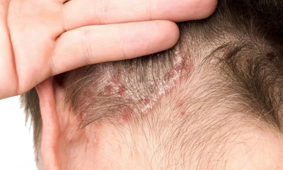 Main d'une personne touchant son cuir chevelu, révélant des plaques rouges et des squames cheveux.