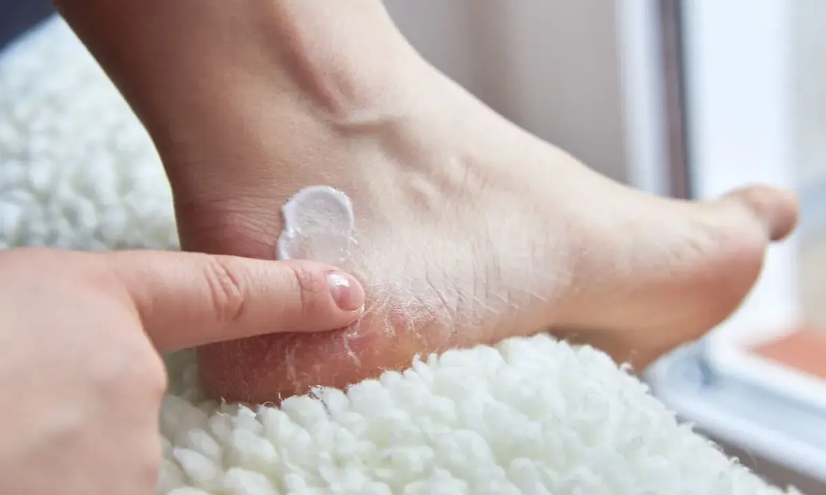 Application d'une crème pour soigner une crevasse au talon, un conseil de podologue pour retrouver des pieds doux.